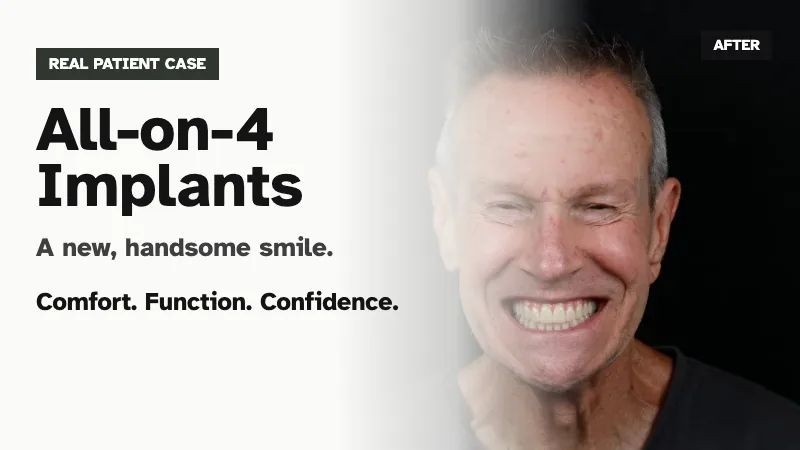 All-on-4 implants top and bottom real patient case thumbnail