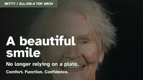All-on-4 top arch real patient case thumbnail