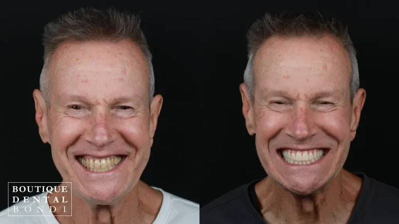 Before and after clinical photographs of one dental implant patient treated by Dr William Choi at Boutique Dental Bondi