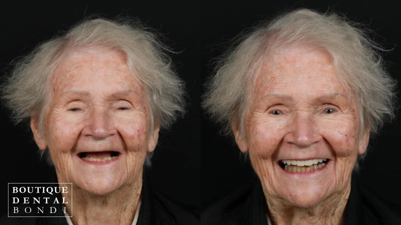 Before and after clinical photographs of one All-on-4 dental implant patient treated by Dr William Choi at Boutique Dental Bondi
