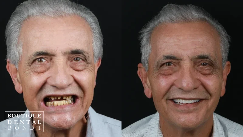 Before and after clinical photographs of one All-on-4 dental implant patient treated by Dr William Choi at Boutique Dental Bondi