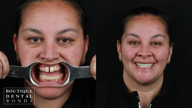 Before and after clinical photographs of one dental implant patient treated by Dr William Choi at Boutique Dental Bondi