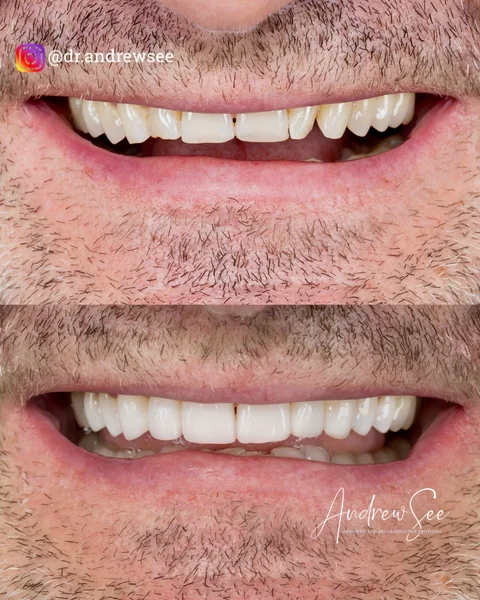 Composite veneers case by Dr Andrew See